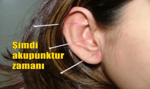 Şimdi akupunktur zamanı