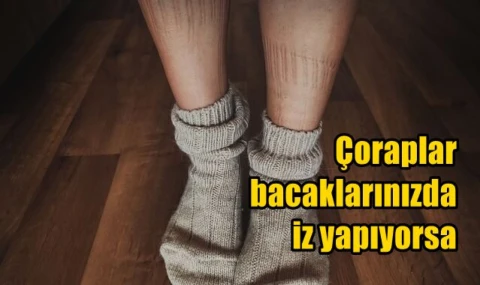 Çoraplar bacaklarınızda iz yapıyorsa